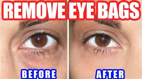 fake tan eye bags|handbags under eyes removal.